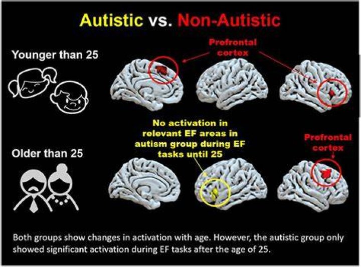 Are autistic brains physically different?