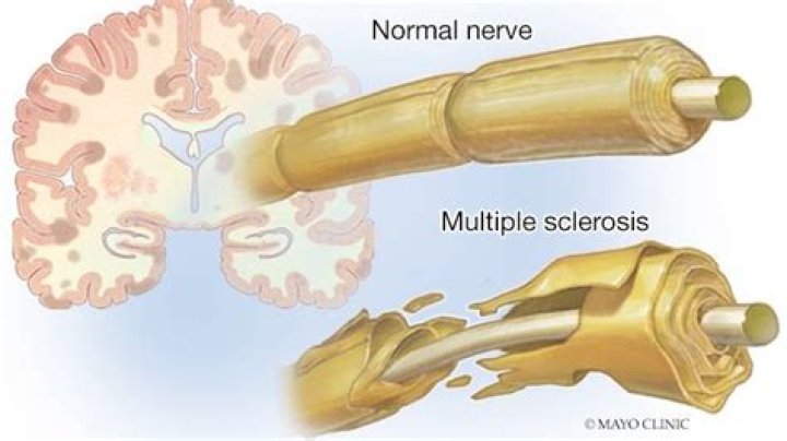 Are reflexes affected by MS?