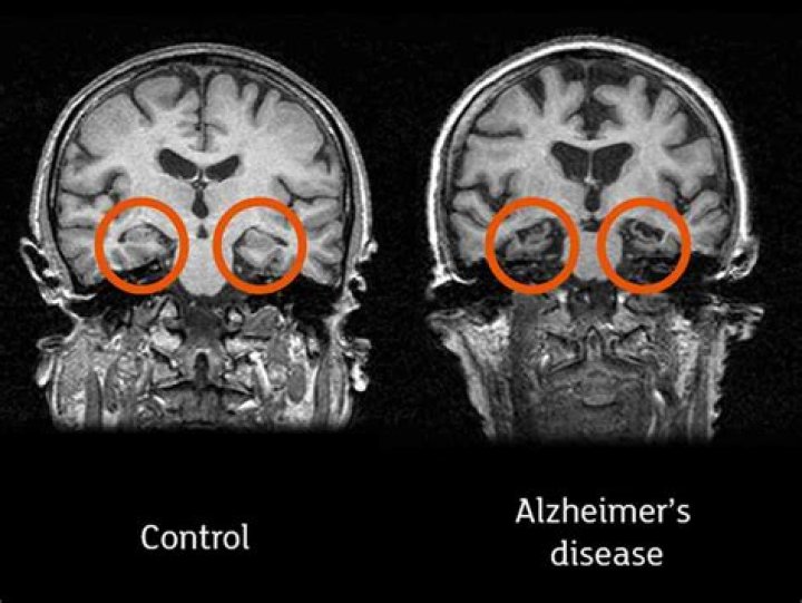 Can a brain MRI show dementia?