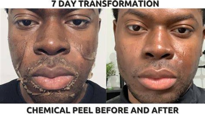 Can A chemical peel remove dark spots?