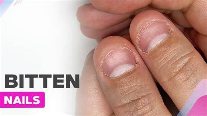 Can a manicure fix bitten nails?