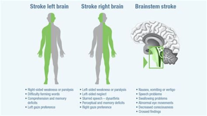 Can a stroke make you talk crazy?