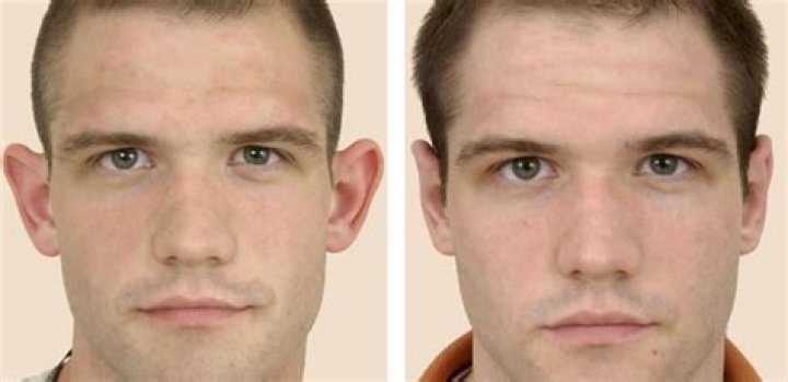 Can adults get their ears pinned back?