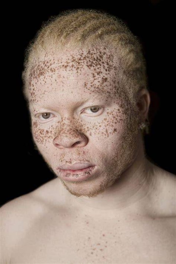 Can albinos have freckles?
