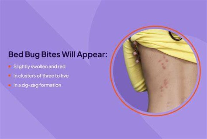 Can bed bugs bite your scalp?