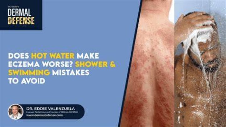 Can hot showers cause eczema?