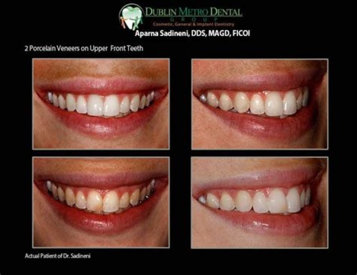 Can I get veneers on just my two front teeth?