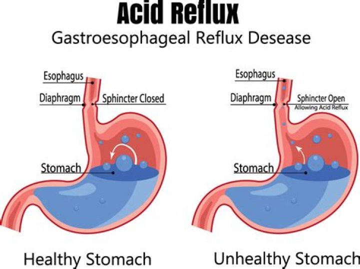 Can kidney issues cause acid reflux?