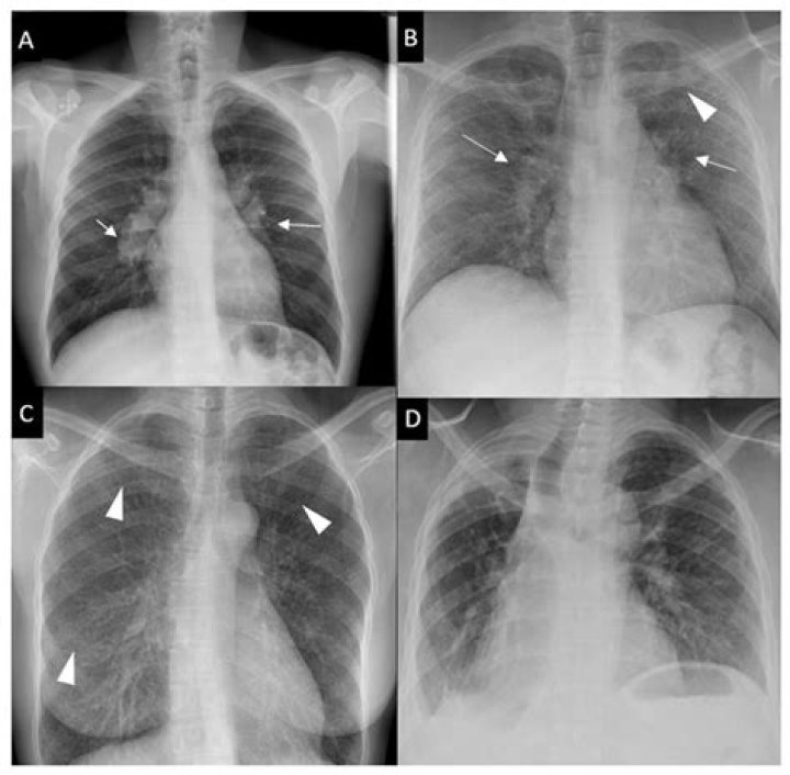Can sarcoidosis be mistaken for IPF?