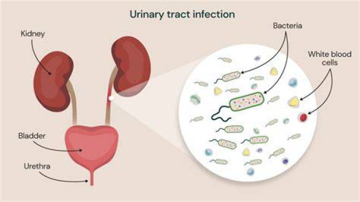 Can sperm cause a UTI?