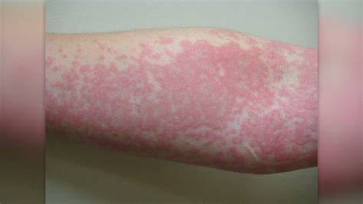 Can you be allergic to the sun?