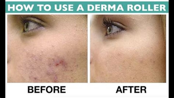 Can you Dermaroll your breasts?