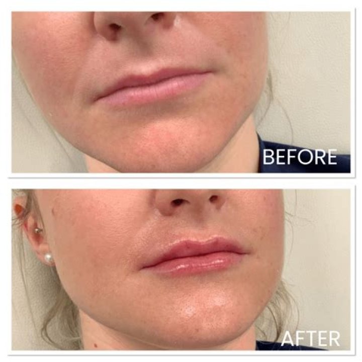 Can you get lip filler if you have psoriasis?