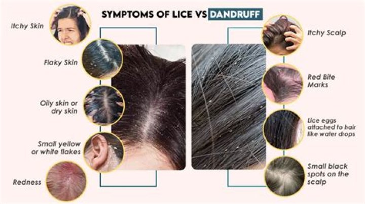 Do lice look like dandruff?
