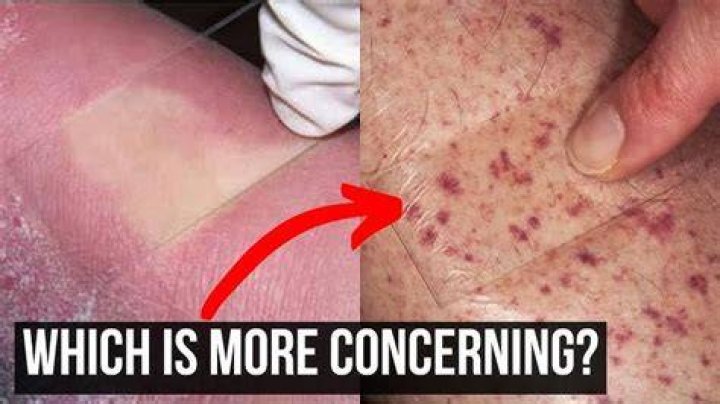 Do skin cancers blanch when pressed?