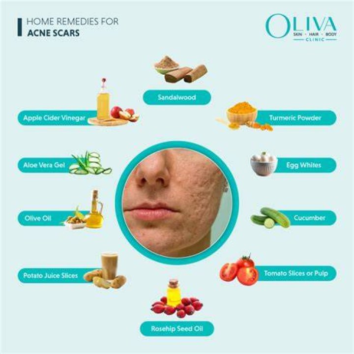 Does drinking water get rid of acne scars?