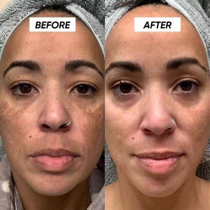 Does exfoliating make hyperpigmentation worse?