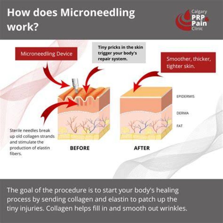Does microneedling thin the skin?