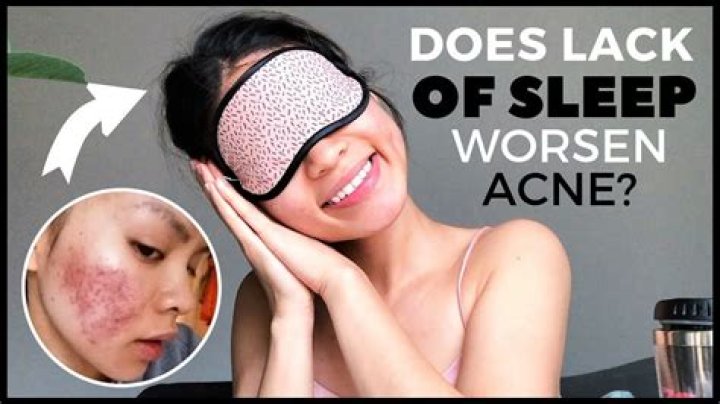 Does sleeping late cause acne?