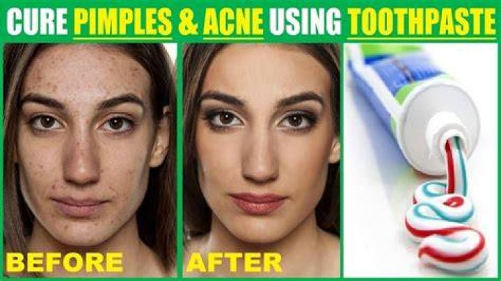 Does toothpaste get rid of dark spots?