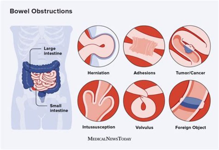How do you fix bowel leakage?