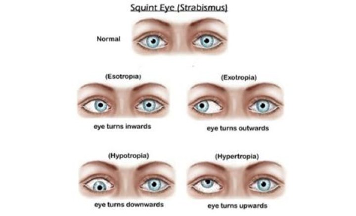 How do you fix squinting eyes?