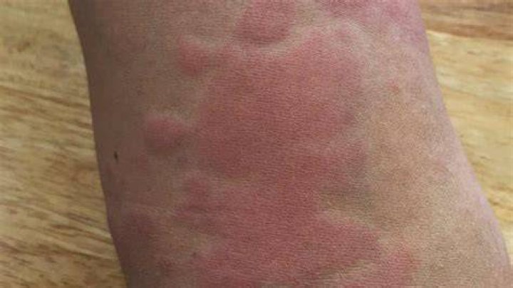 How do you get rid of a rash that won't go away?