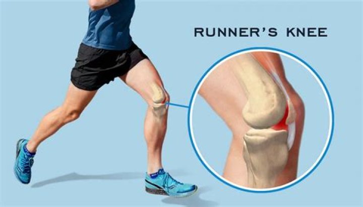 How do you get runners knee?