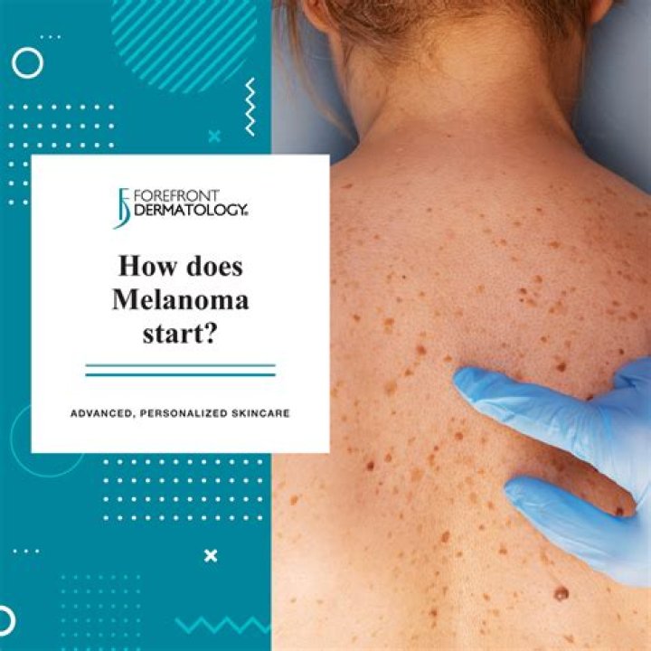 How do you know if melanoma has spread?