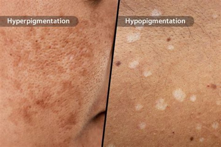 How do you stop pigmentation from spreading?