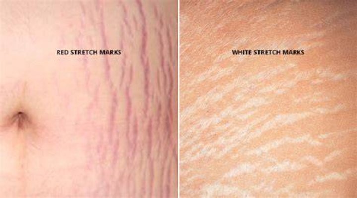 How long do stretch marks take to turn white?