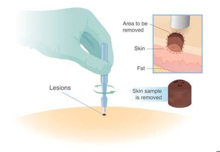 How long does a biopsy for melanoma take?