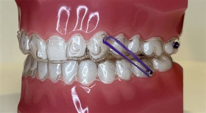 How old do u have to be to get an Invisalign?