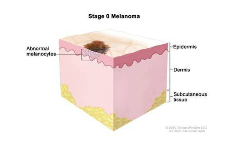 How thick is melanoma in situ?