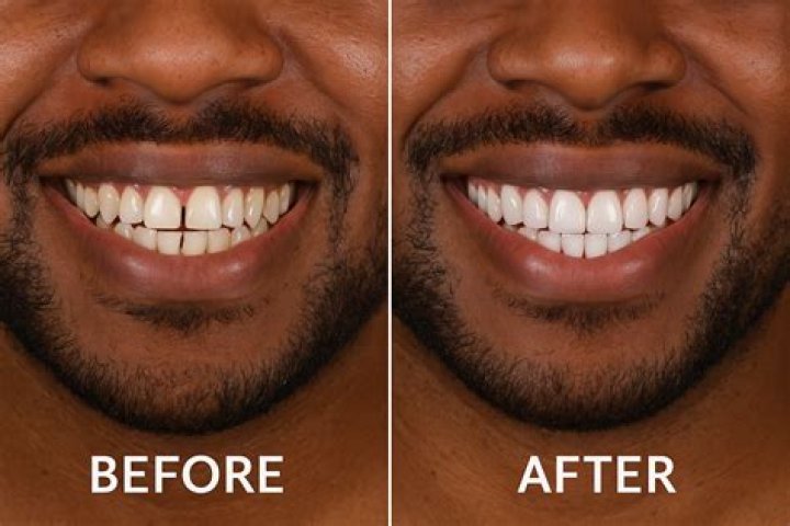 Is 65 too old for veneers?