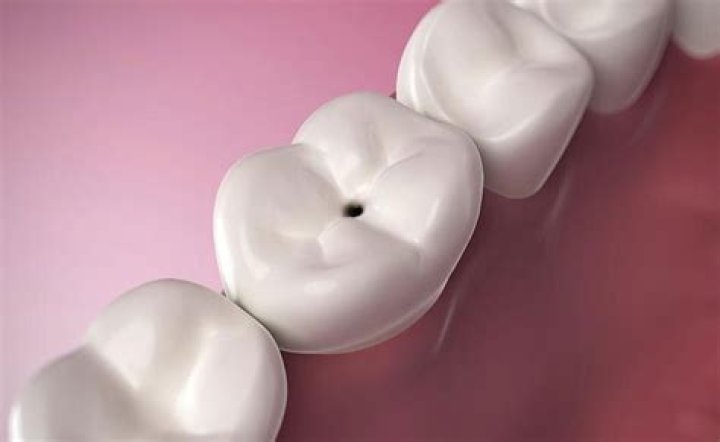 Is a black spot on tooth a cavity?