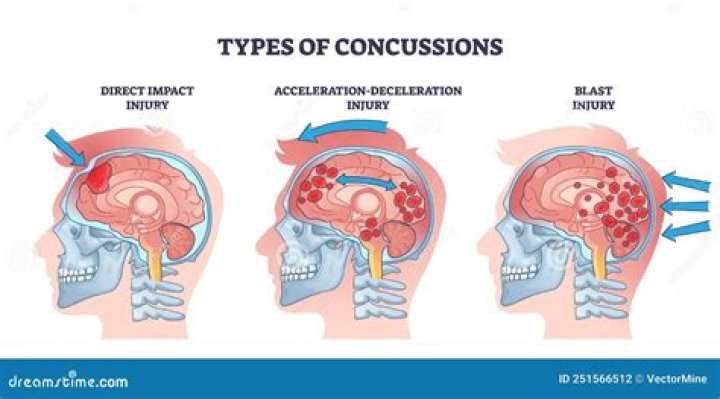 Is every bump on the head a concussion?
