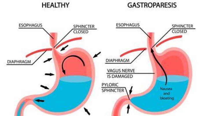 Is gastroparesis a big deal?