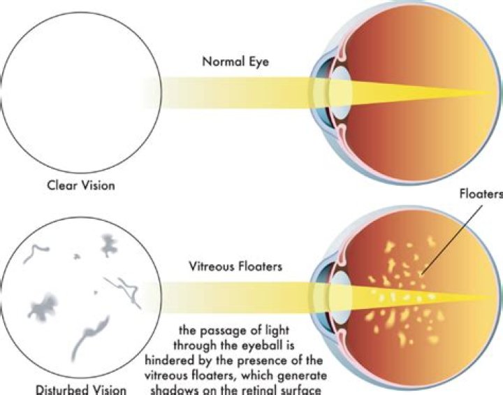 Is it normal to have floaters in your eyes?