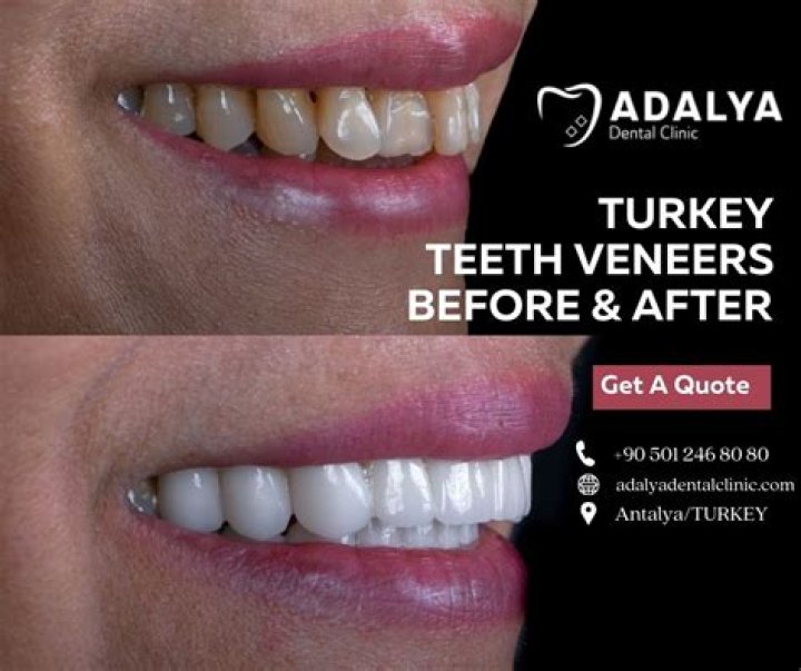 Is it worth getting veneers in Turkey?