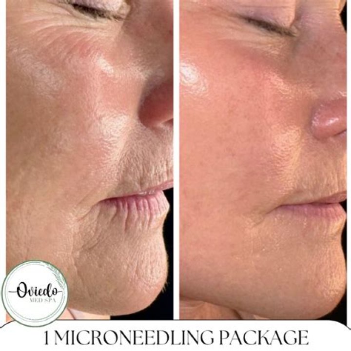 Is one session of microneedling enough?