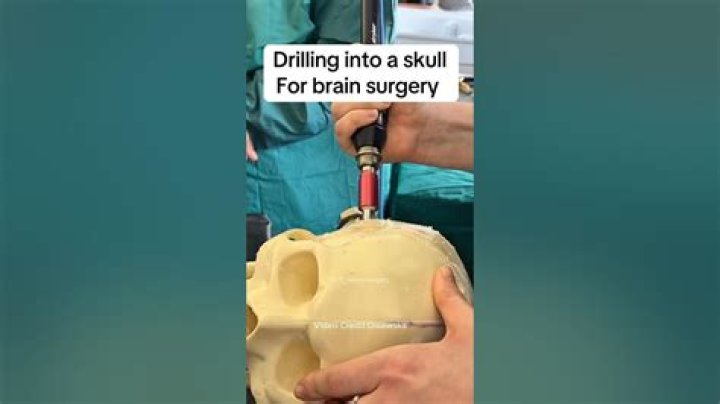 Is the skull removed during brain surgery?