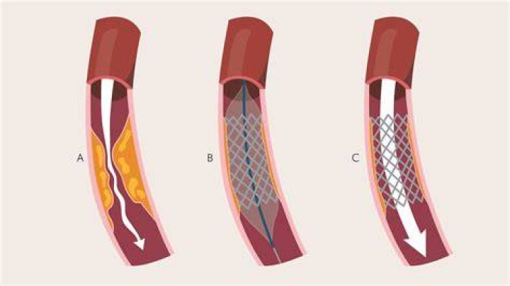 Should I get a stent or not?