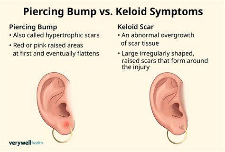 Should you pop a piercing bump?