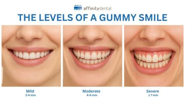 Should your gums show when you smile?
