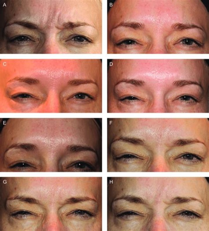 What are glabellar lines?