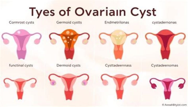 What causes ovarian cysts to flare?