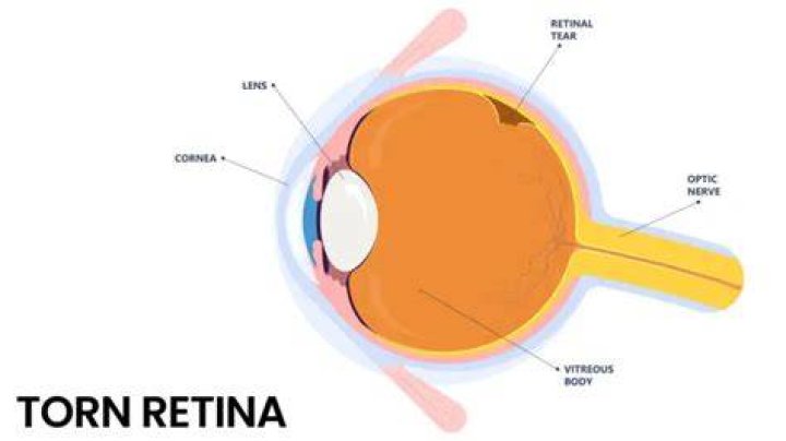 What causes retina issues?
