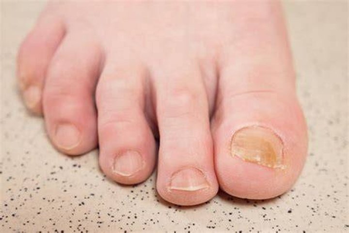 What color are toenails supposed to be?