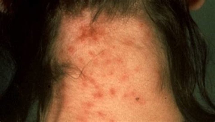 What do head lice bites look like?